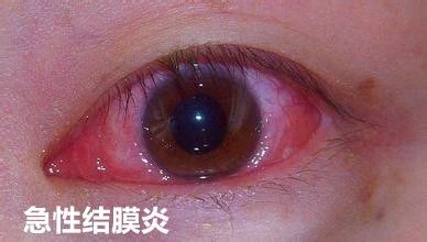 科普 | 世界杯來(lái)了，眼科醫生又要加班了