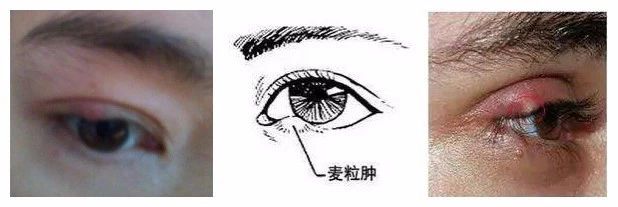 科普 | 世界杯來(lái)了，眼科醫生又要加班了